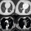Lungcancerscan 750x684 1