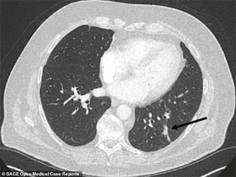 Lungcancerscan2